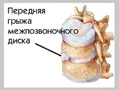 Грыжа межпозвонкового диска